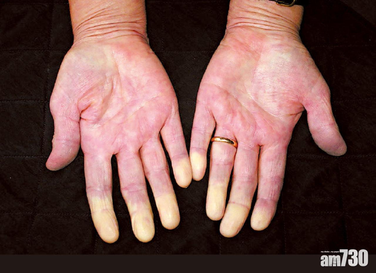 九成患者在病發初期已會出現『雷諾氏現象』，手腳的微血管異常收縮，例如在氣溫下降時手指會變白甚至發藍，而且暖手超過15分鐘才會變回紅潤。