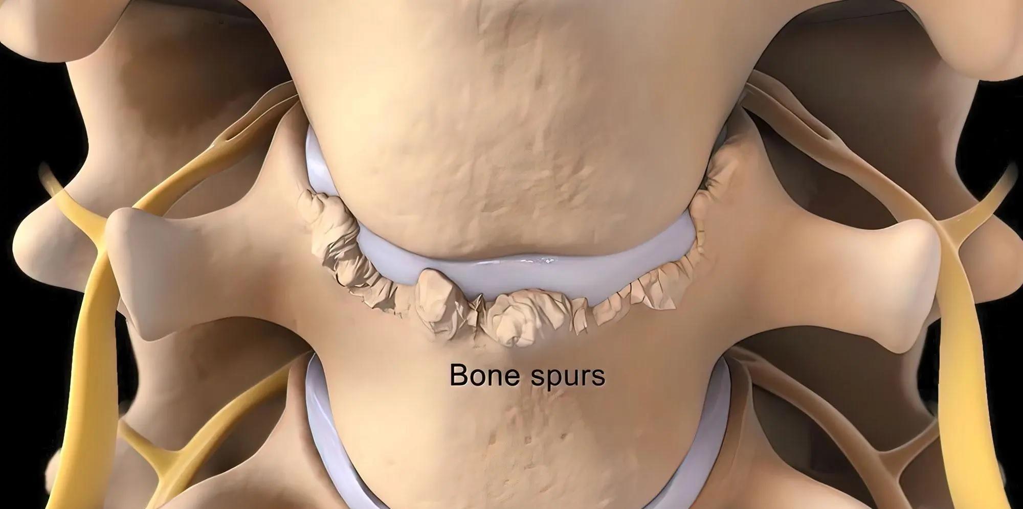 骨刺治療｜不只長者才會骨質增生壓住神經線　打工仔關節勞損都有風險