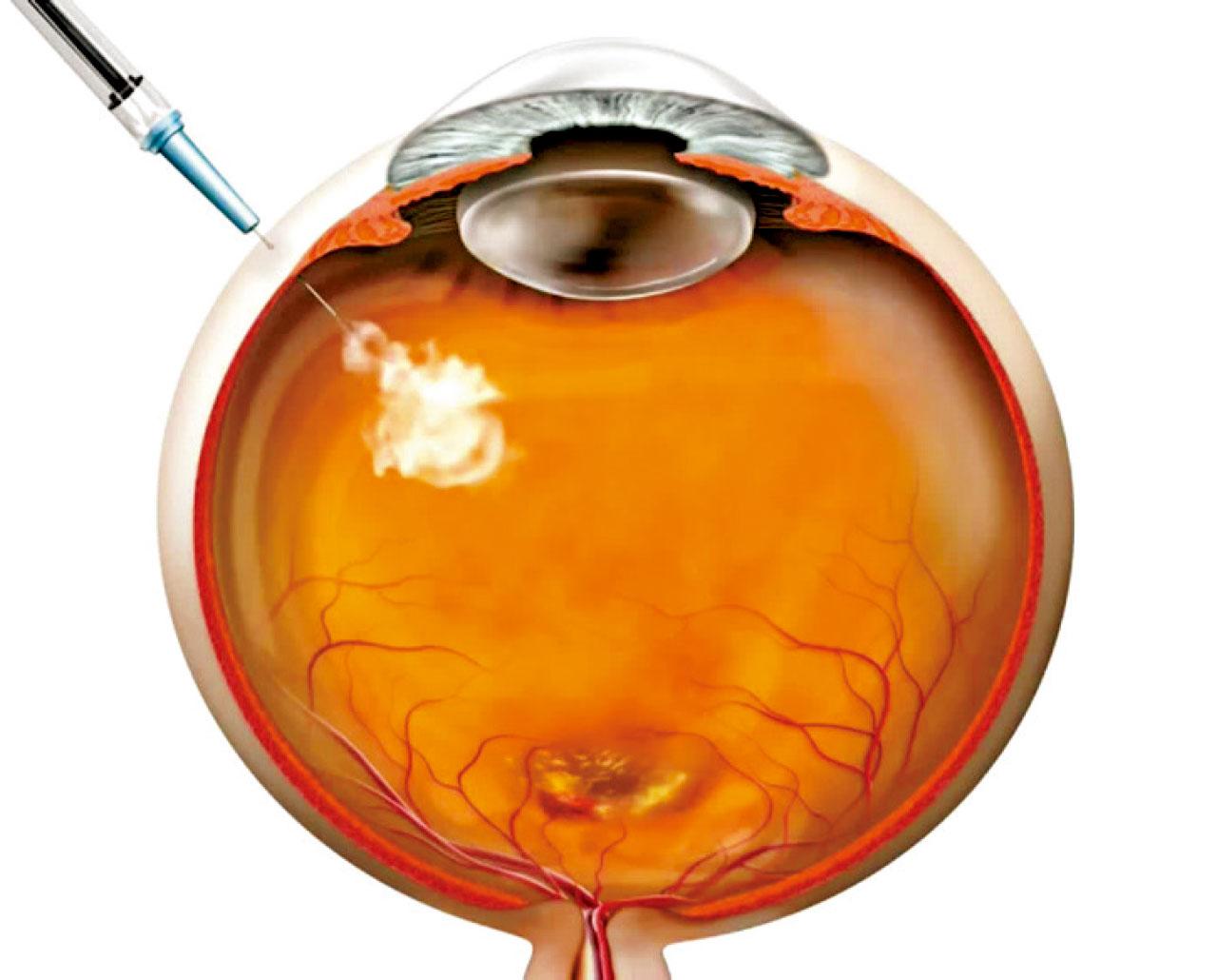 治療老年黃斑病變