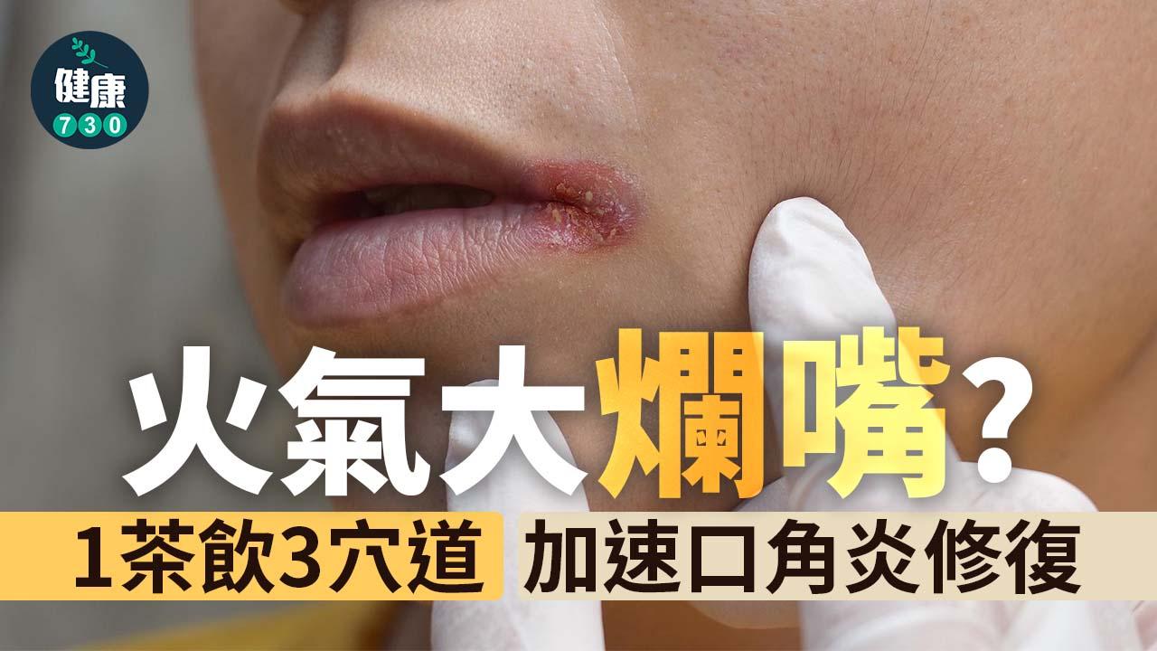 火氣大爛嘴？中醫：脾胃之火非主因 2方法降低發作頻率