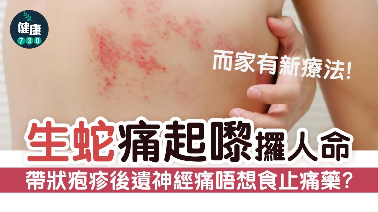 生蛇｜痛起嚟攞人命！帶狀疱疹後遺神經痛唔想食止痛藥？而家有新療法