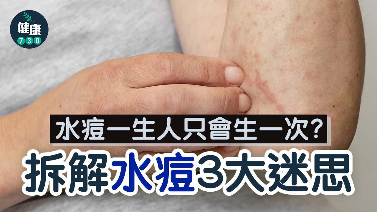 水痘｜水痘一生人只會生一次？有機會復發變成呢個病？拆解關於水痘的3大迷思！