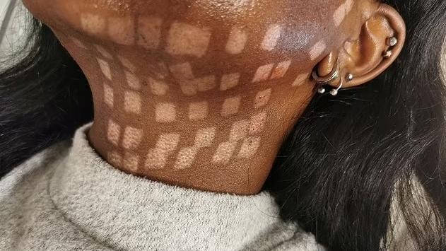 莫約頸部皮膚燒傷的部分脫皮後，呈現出一個個方格。(互聯網)