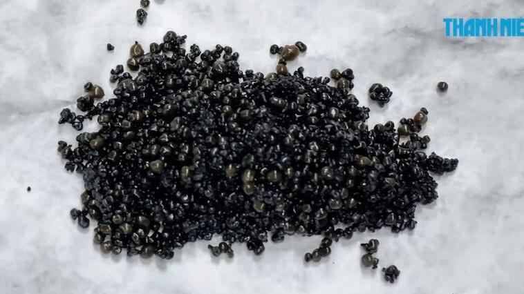 男子膽囊裡的結石數量驚人。(互聯網)