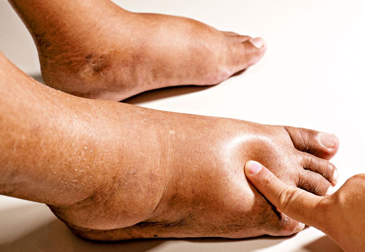 長者足部護理(五)：雙側腳腫