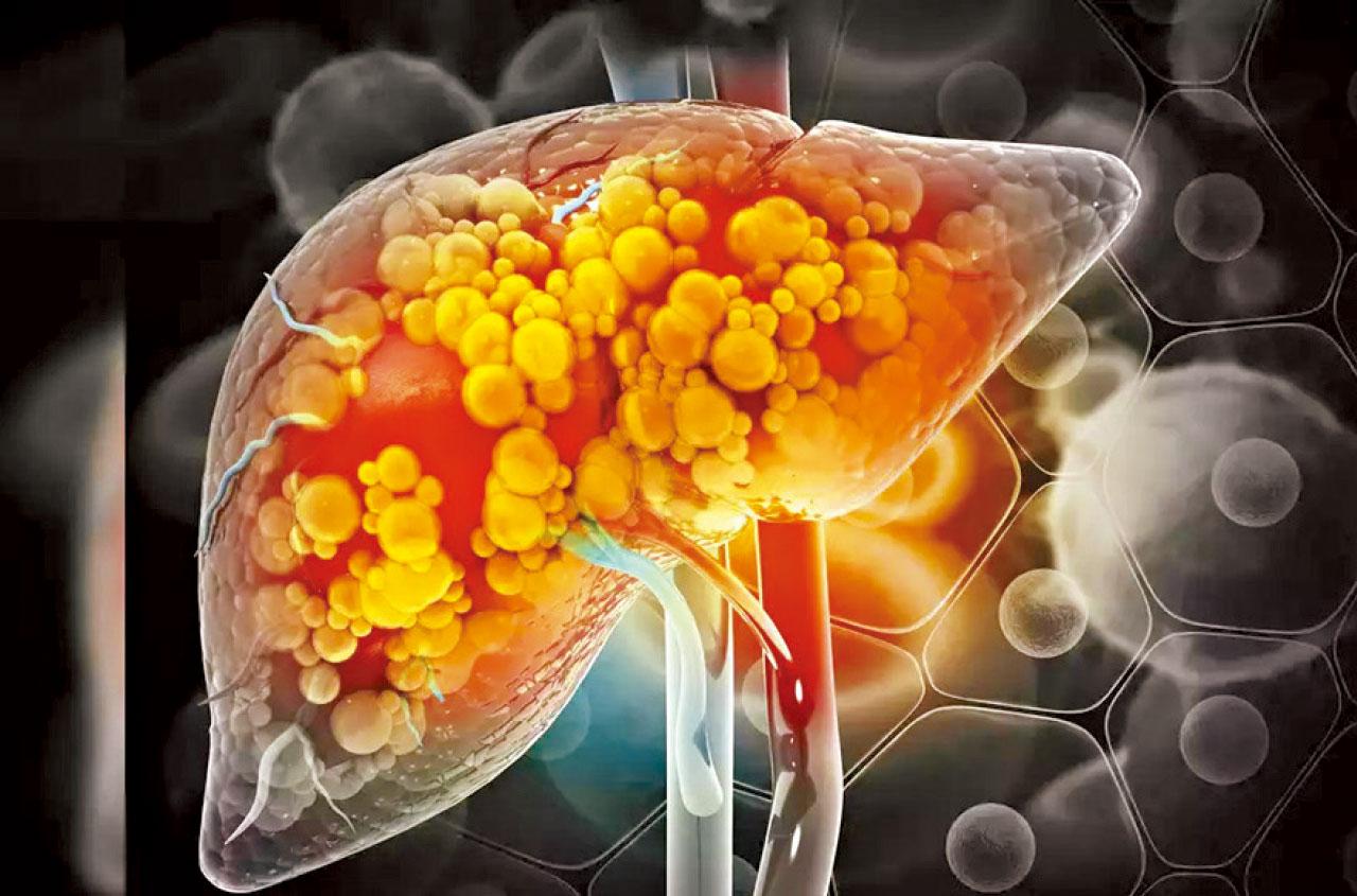 重視脂肪肝的飲食調理