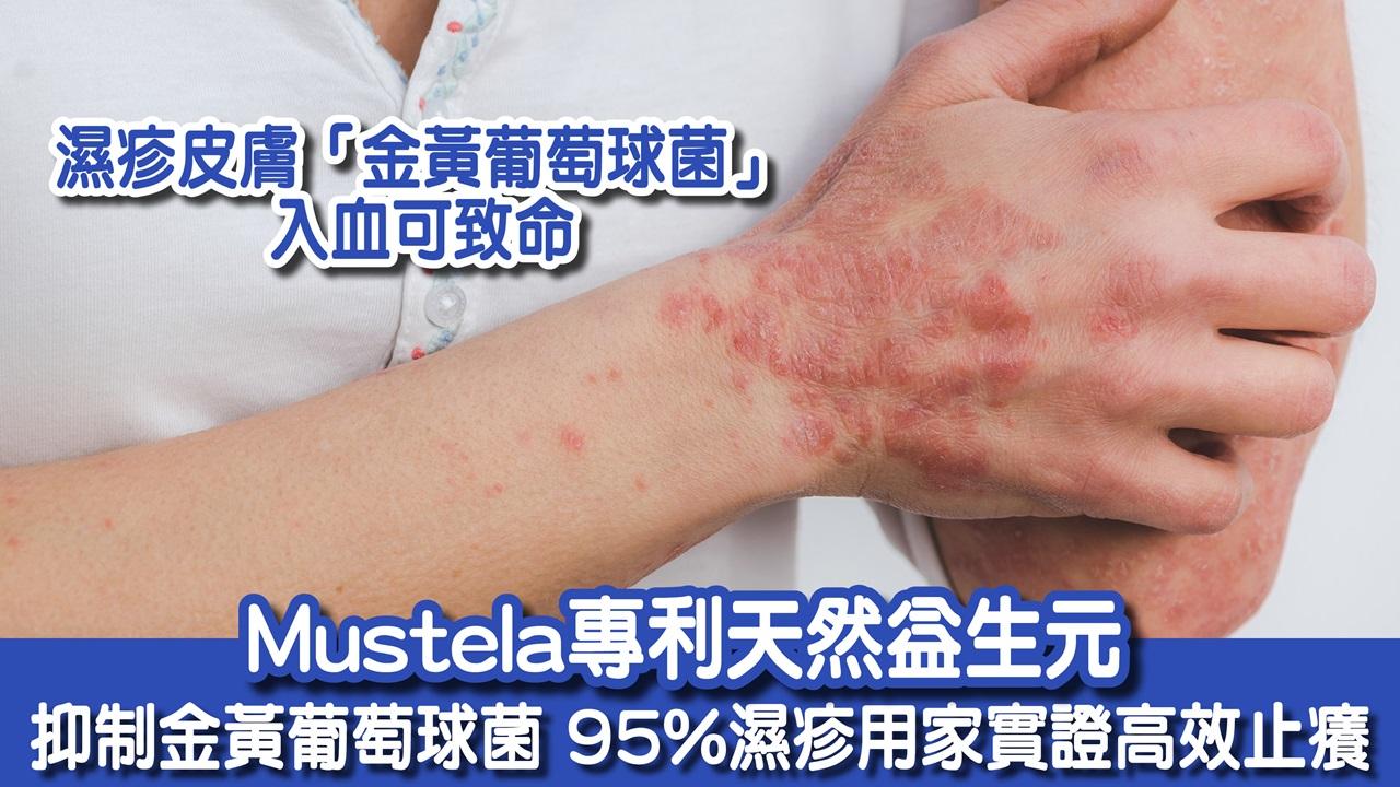 濕疹皮膚「金黃葡萄球菌」入血可致命 Mustela專利天然益生元 抑制金黃葡萄球菌  95%濕疹用家實證高效止癢 