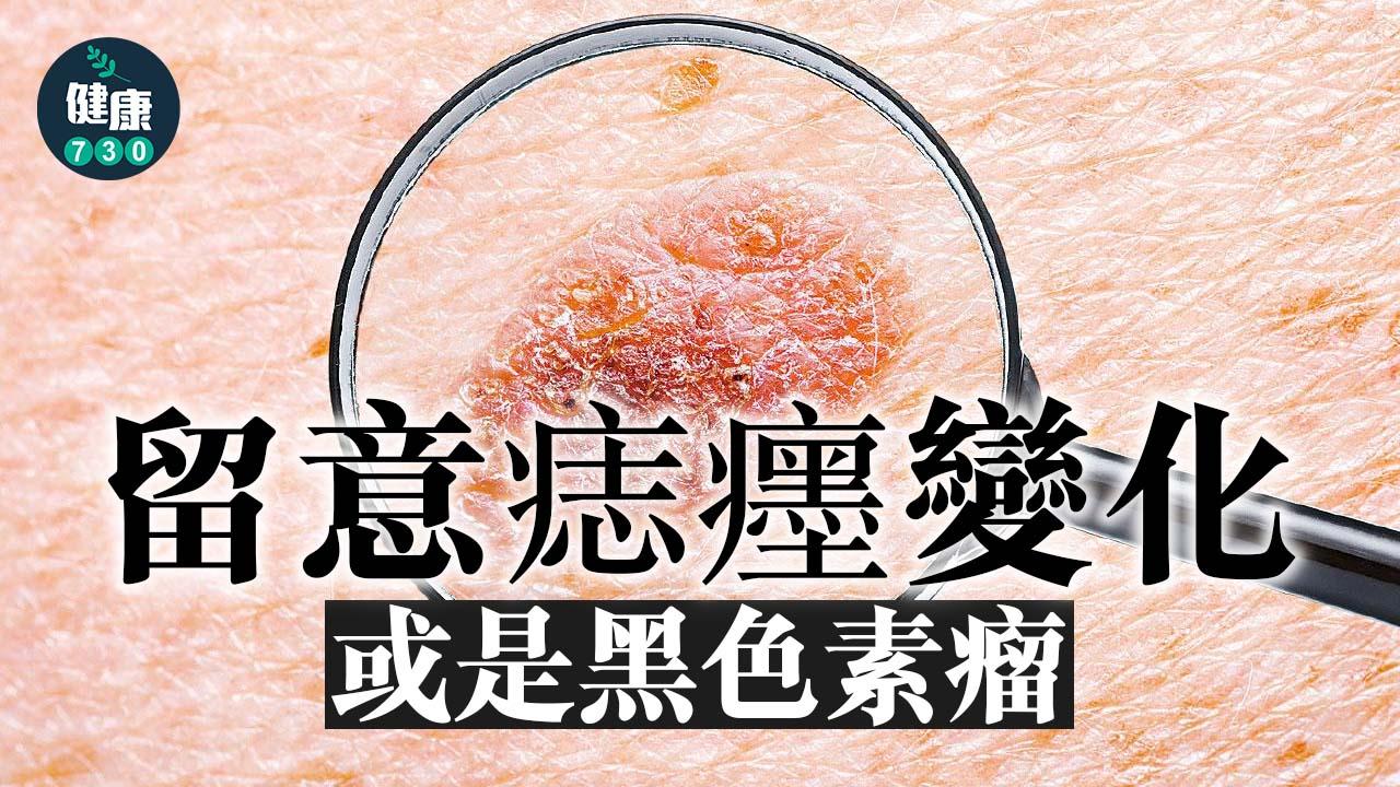 留意痣癦變化 或是黑色素瘤