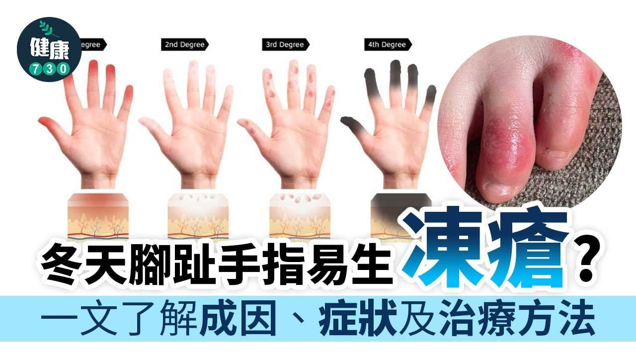凍瘡成因、症狀及治療 一文了解冬天腳趾/手指易生「蘿蔔仔」及保暖方法（am730製圖）