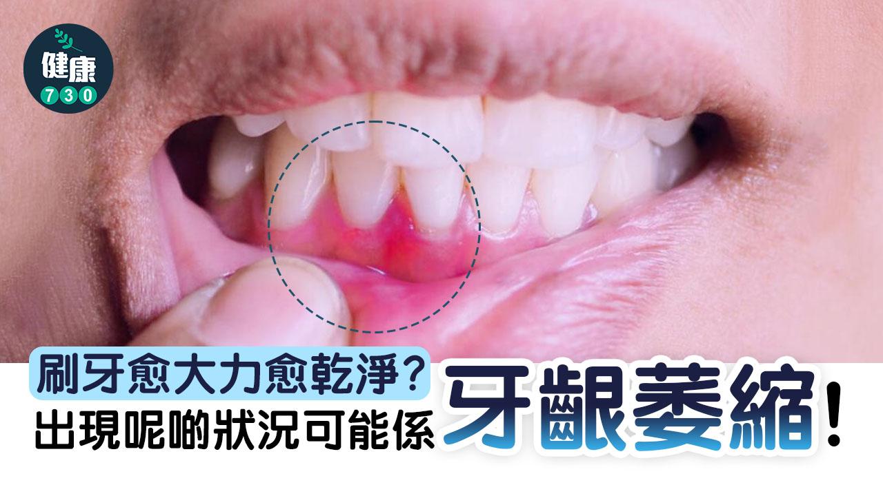 刷牙愈大力愈乾淨？出現呢啲狀況可能係牙齦萎縮！