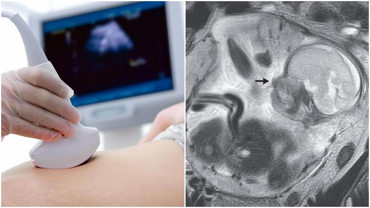 法女胃痛10日闖急症室，驚揭胎兒生長於腸道。(網上圖片)