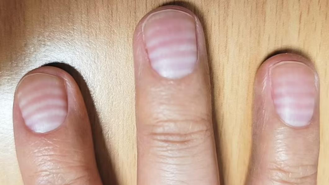 指甲現詭異白線原來是副作用，醫生揭倘指甲有這現象恐患癌。(網上圖片)