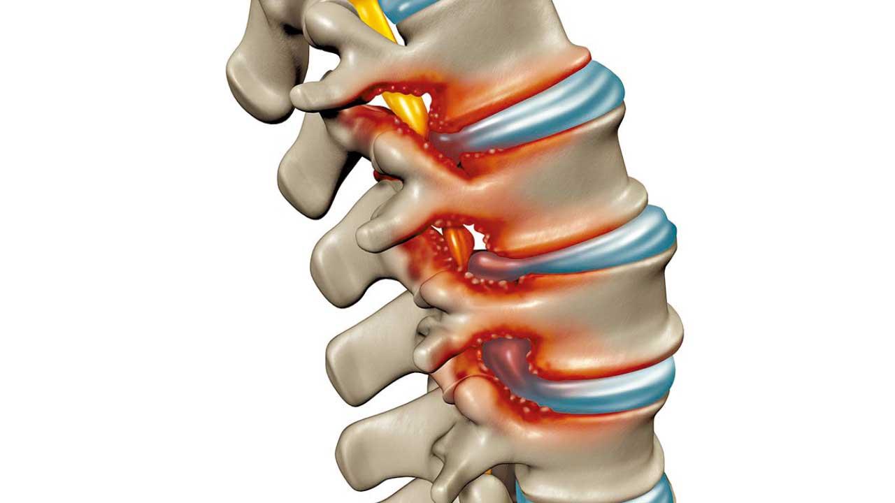 骨刺不等於椎間盤突出