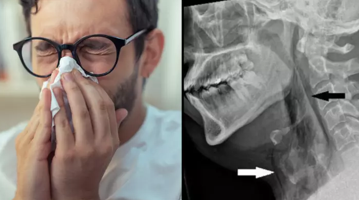 一名年約30多歲男子駕車時欲打噴嚏，他捏鼻閉嘴強忍，結果令氣管撕裂。(左圖非當事人)