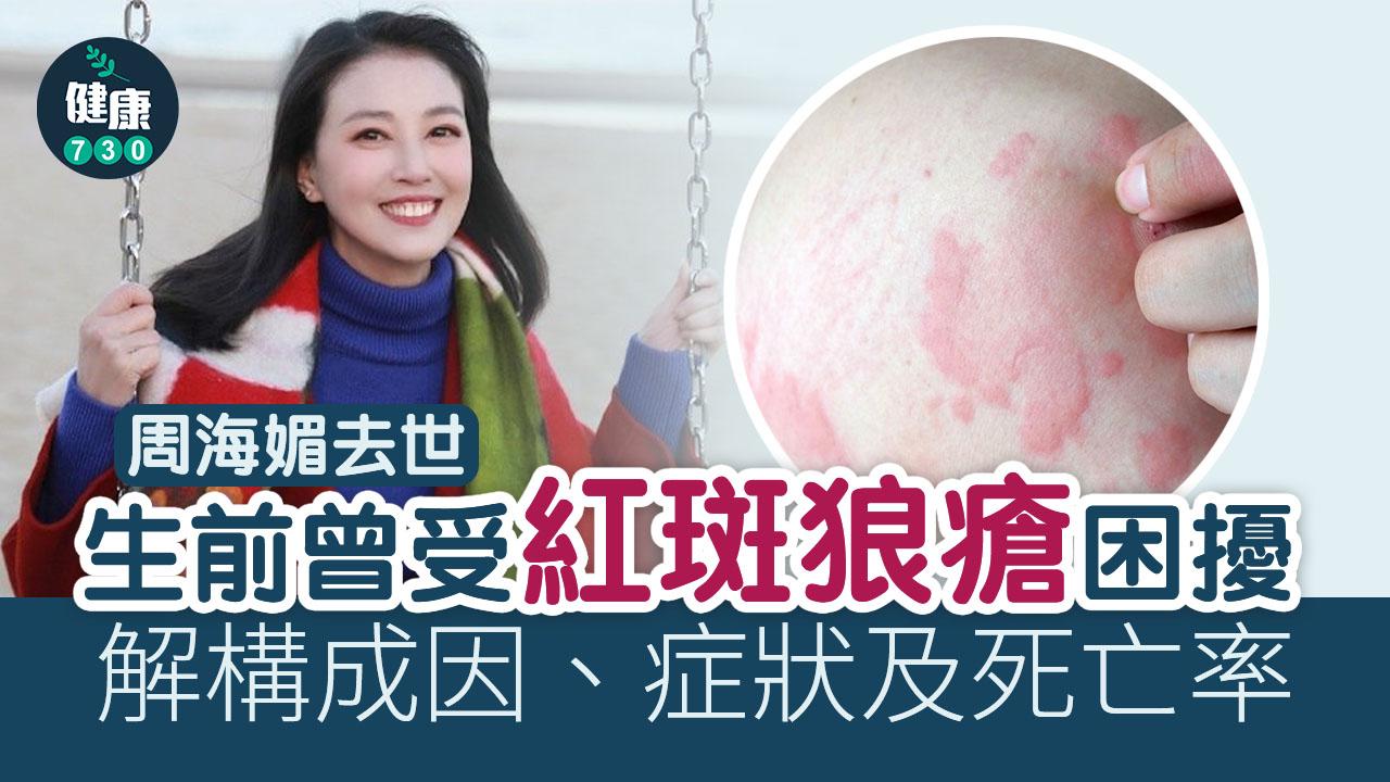 周海媚去世｜生前曾受紅斑狼瘡困擾 解構成因、症狀及死亡率