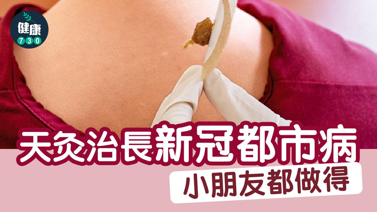 天灸治長新冠都市病 小朋友都做得