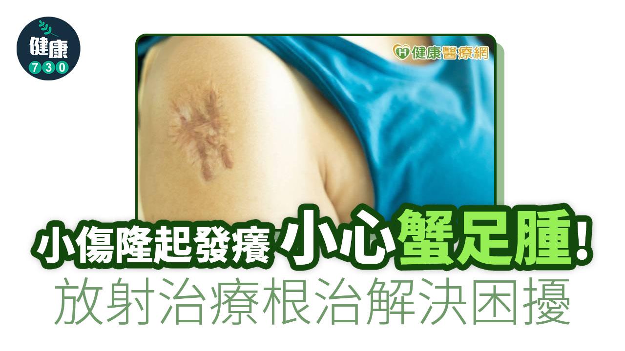 蟹足腫｜不只用在癌症！蟹足腫影響外觀 放射治療根治解決困擾