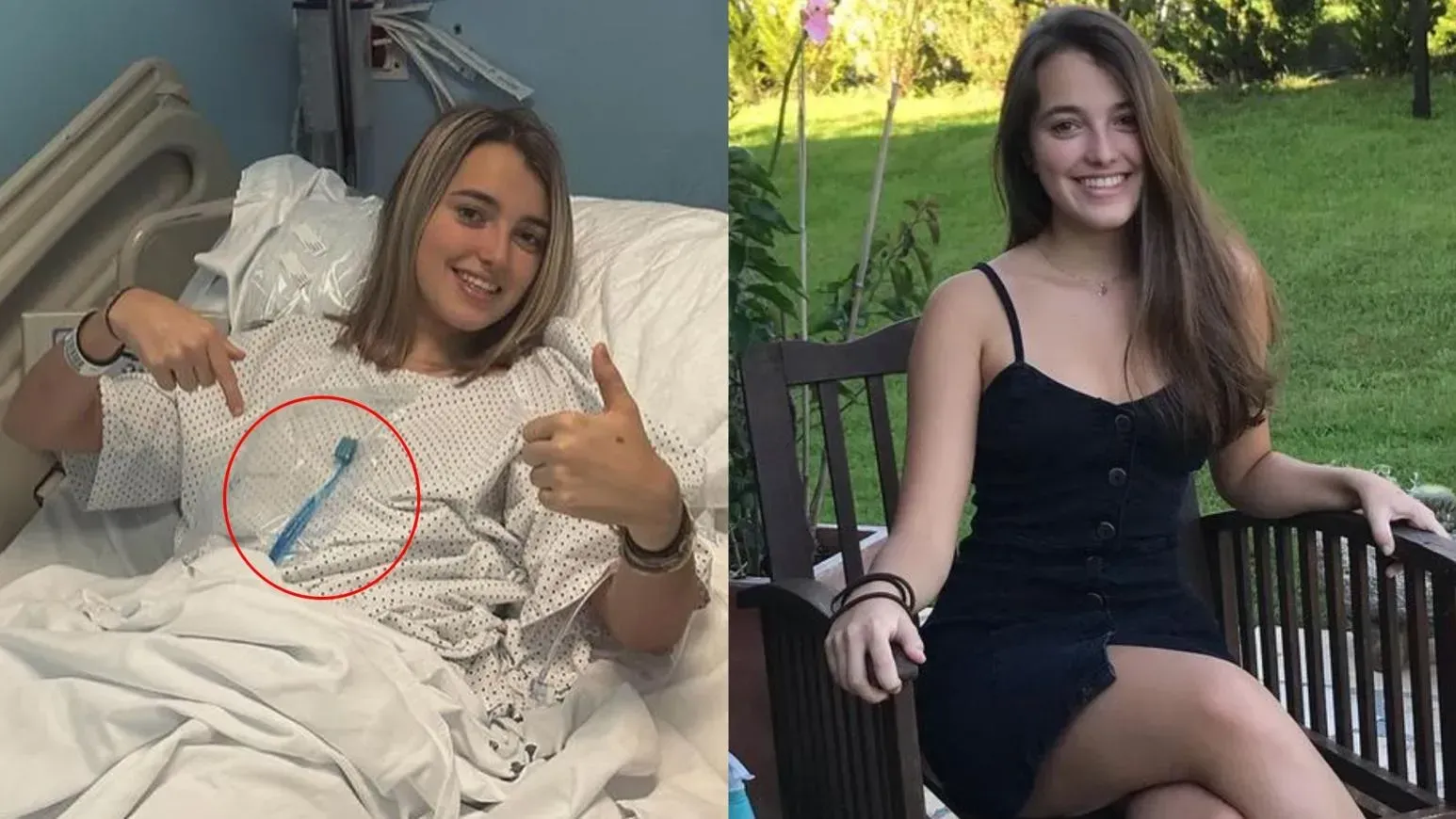 西班牙21歲女食火雞鯁親　用20厘牙刷去撈反致整支卡喉嚨