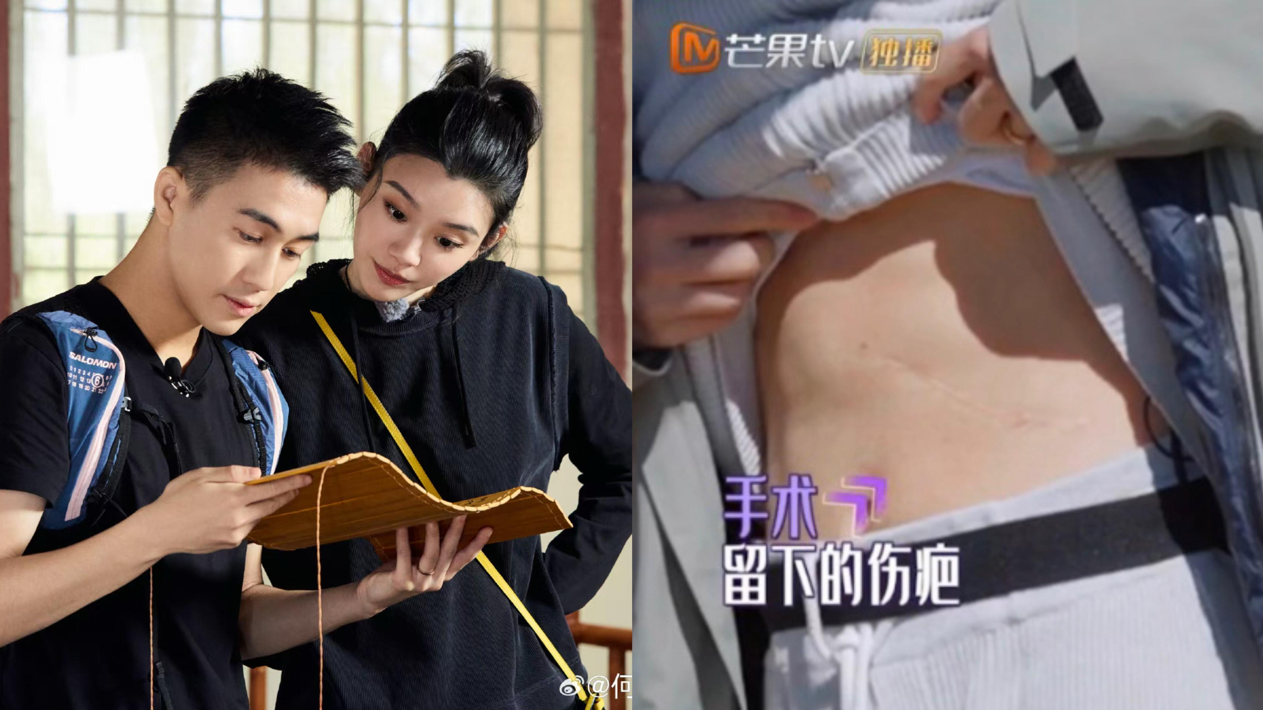 何猷君罕有公開疤痕 自爆童年生腫瘤致阻礙發育