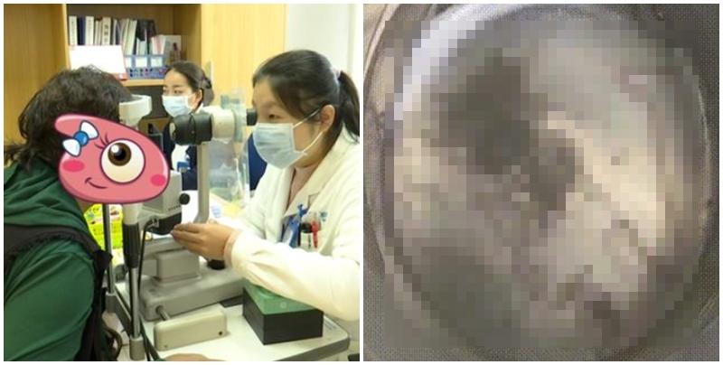 雲南昆明一名女子近日眼睛不舒服，揉眼時竟掉出一條蟲在手上爬，她大驚趕赴醫院就診。醫生檢查時翻開眼皮，能看到一條條絲線樣的白色寄生蟲不停地蠕動，最終從右眼取出40多隻蟲子，左眼取出10多條。