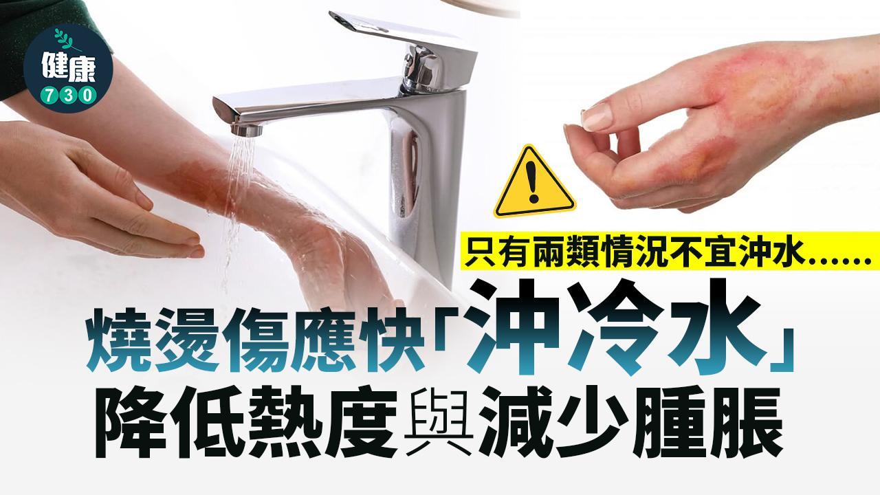 燙傷處理｜網傳「燒燙傷不能沖冷水」？醫生：沖水才能降溫！（am730製圖）