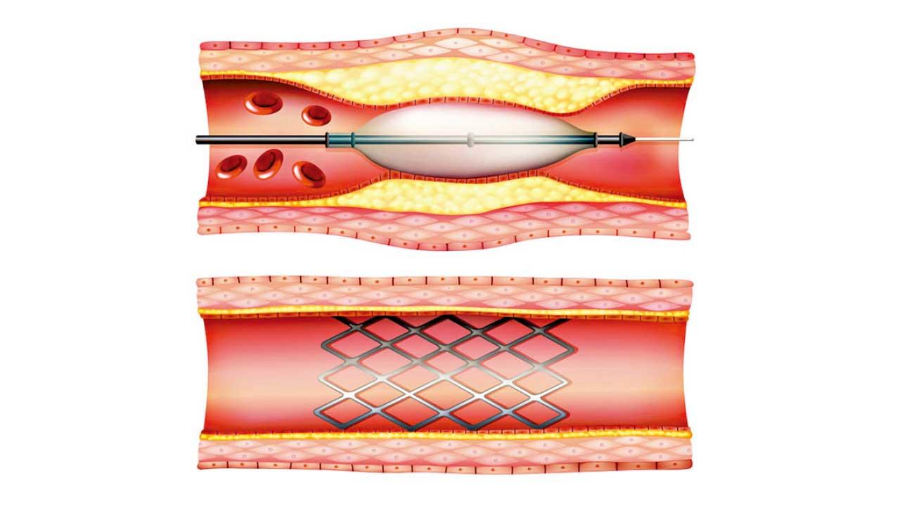 通波仔手術 重拾心血管健康