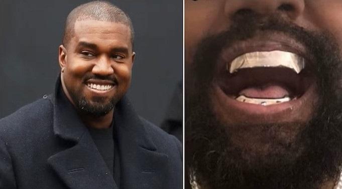 Kanye West花660萬鑲鈦合金假牙