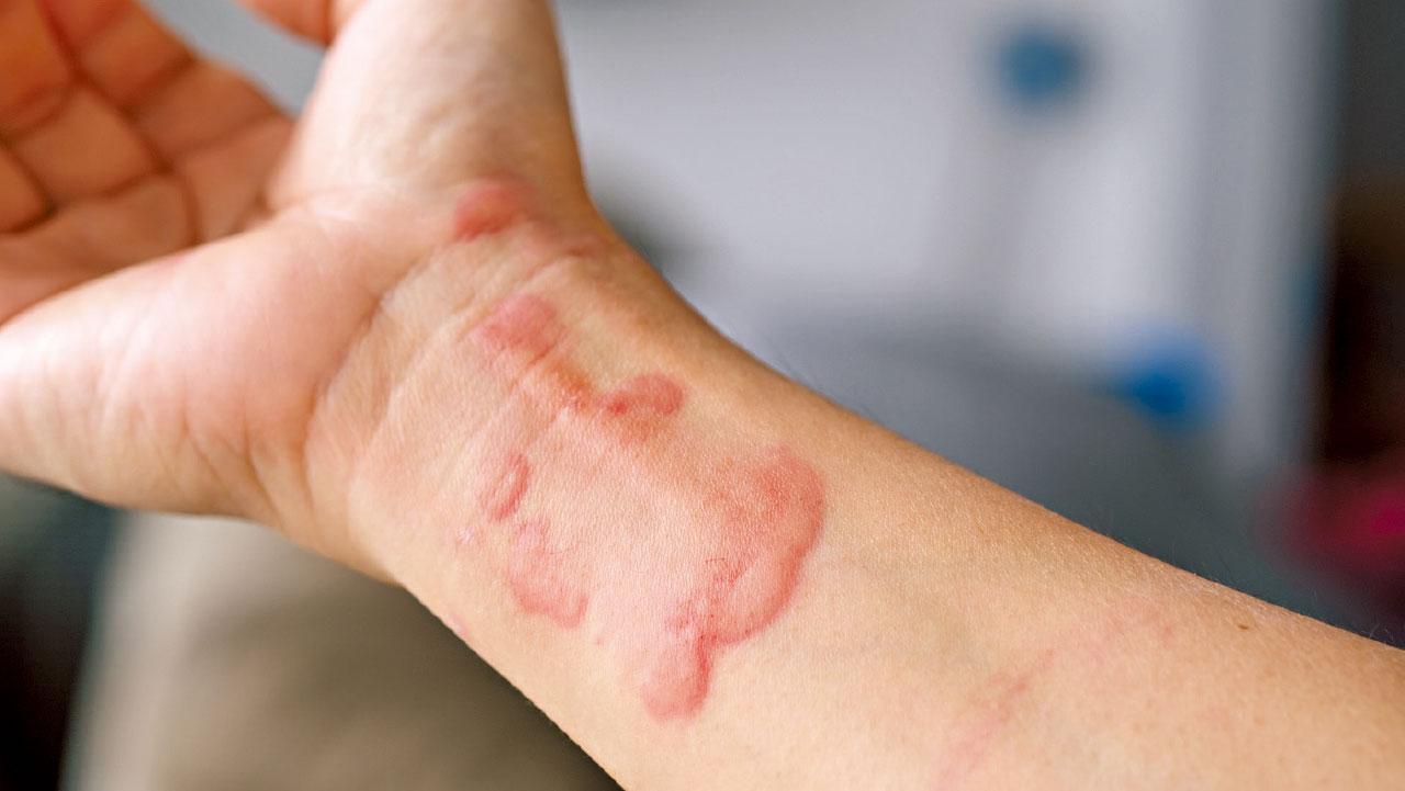 反覆發作難找病因 蕁麻疹 嚴重可致命