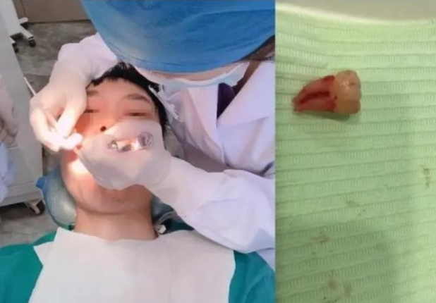 湖南一名23歲男子畢業後，到深圳擔任汽車工程師，惟去年到當地醫院拔智慧齒後，在拍X光片的診室內突然暈倒，轉到急診科診治期間出現噴射狀嘔吐及抽搐。他要接受開顱手術，兩周後不治身亡。當地衛健部門已介入調查事件。