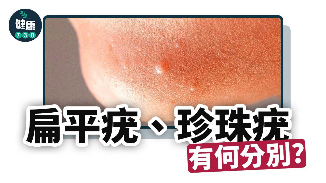 扁平疣、珍珠疣有何分別？