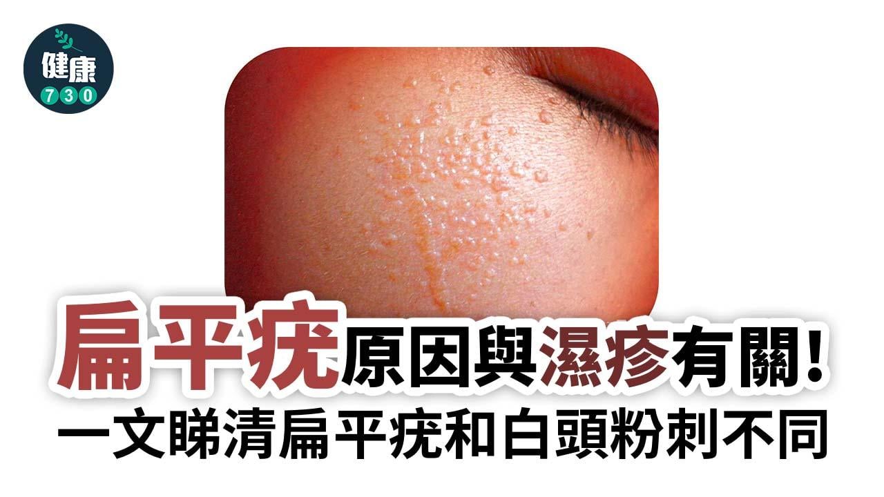 扁平疣原因與濕疹有關 傳染力強勿擠破！