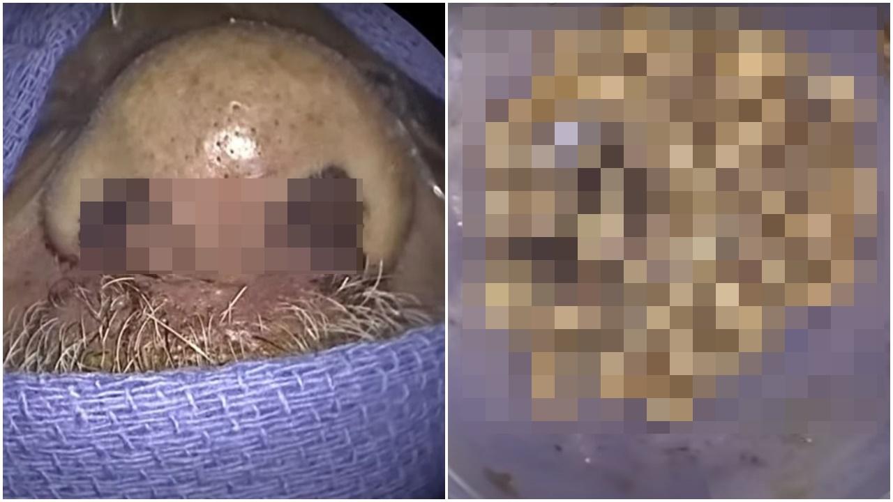 男子面腫狂流鼻血，醫生從鼻吸出150隻活蟲。(YouTube)