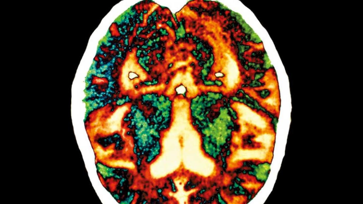 患者兒時接受荷爾蒙治療  英研究：阿茲海默症可人傳人