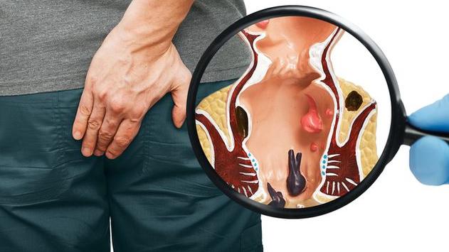 現代人文明病！痔瘡保守治療無效怎辦？　「3種手術」選擇看這