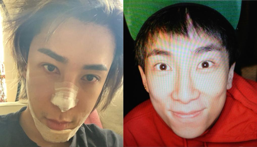 馬天佑突公開整容前後照  剖白清拆隆鼻和假體下巴的心路