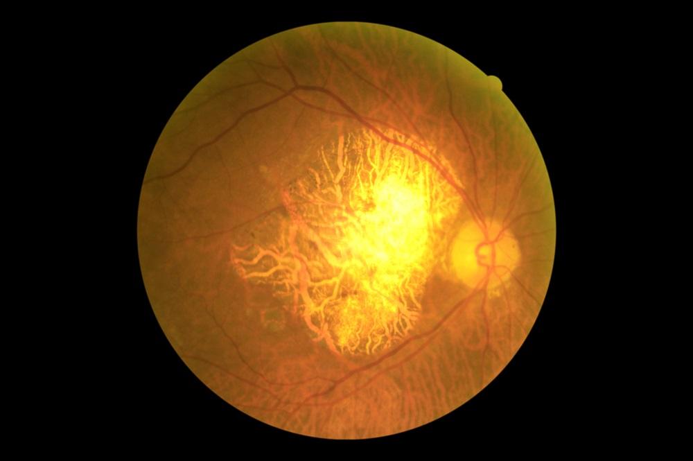 乾性黃斑病變無藥可治？