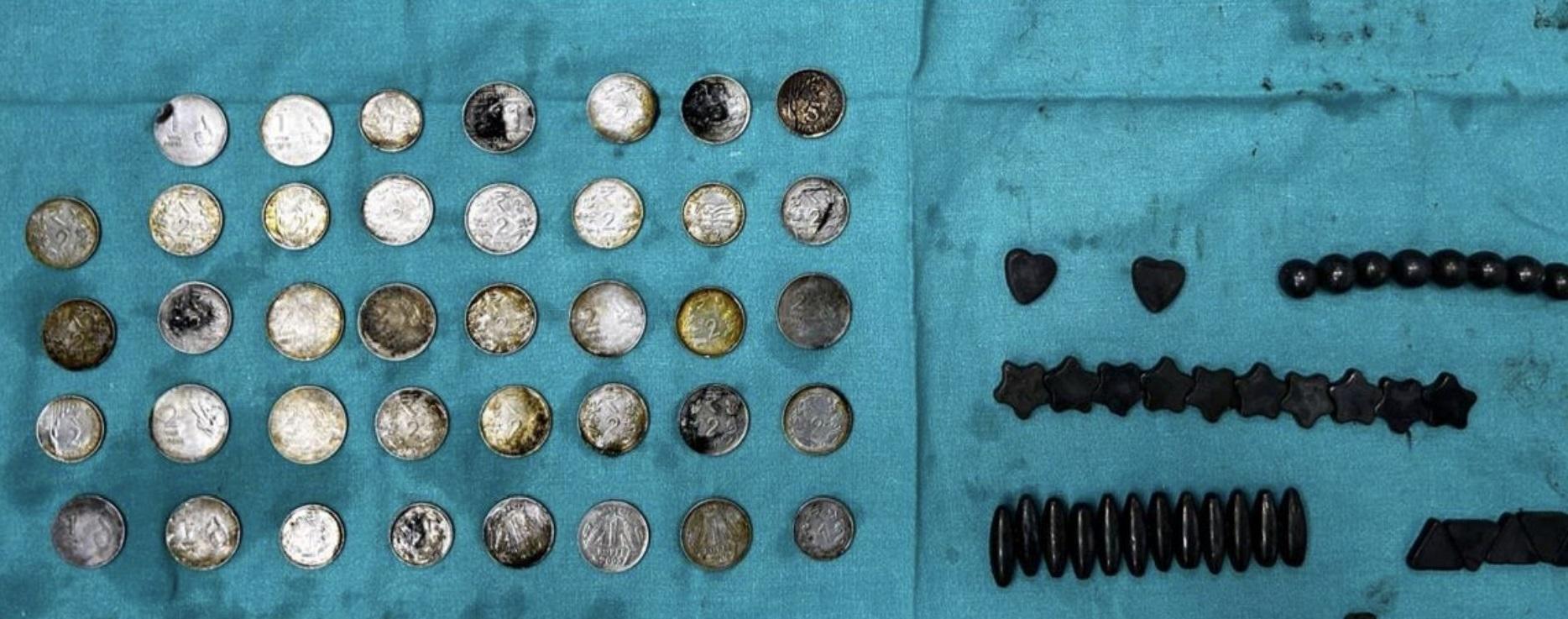 醫生在青年的胃部和小腸取出大量硬幣和磁鐵。(互聯網)