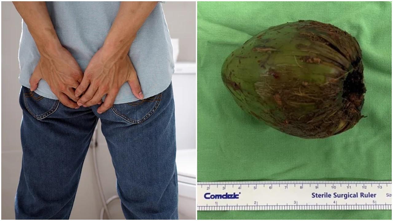 高雄男肛門塞椰子要開刀，網民：那椰子很大。