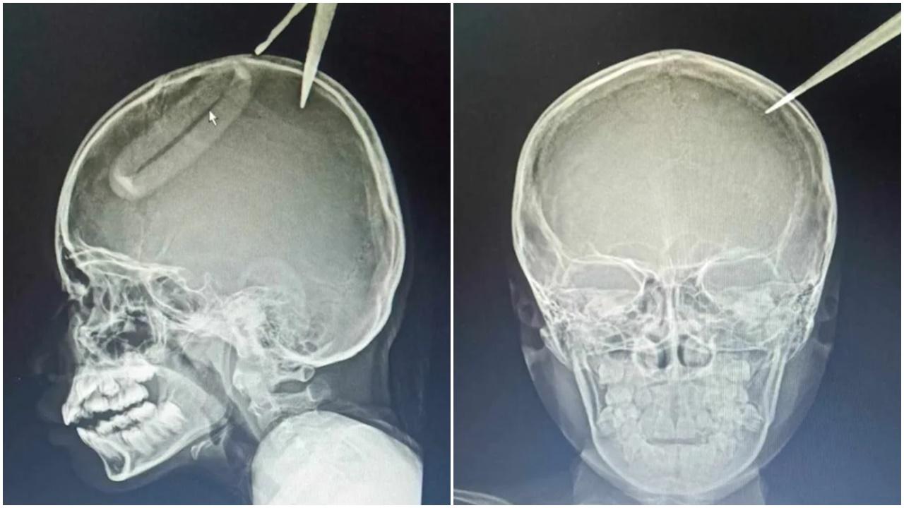 4歲男童模仿電視掟飛刀，鉸剪意外插穿姐姐頭骨。(網上圖片)
