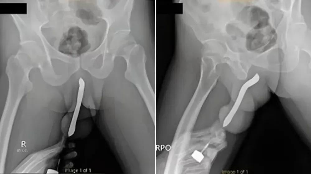 印尼男為達到高潮陰莖開窿塞牙刷　激戰時下體骨折致腫如茄子