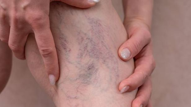 靜脈曲張不僅外觀受影響　醫生曝更有猝死、休克可能！