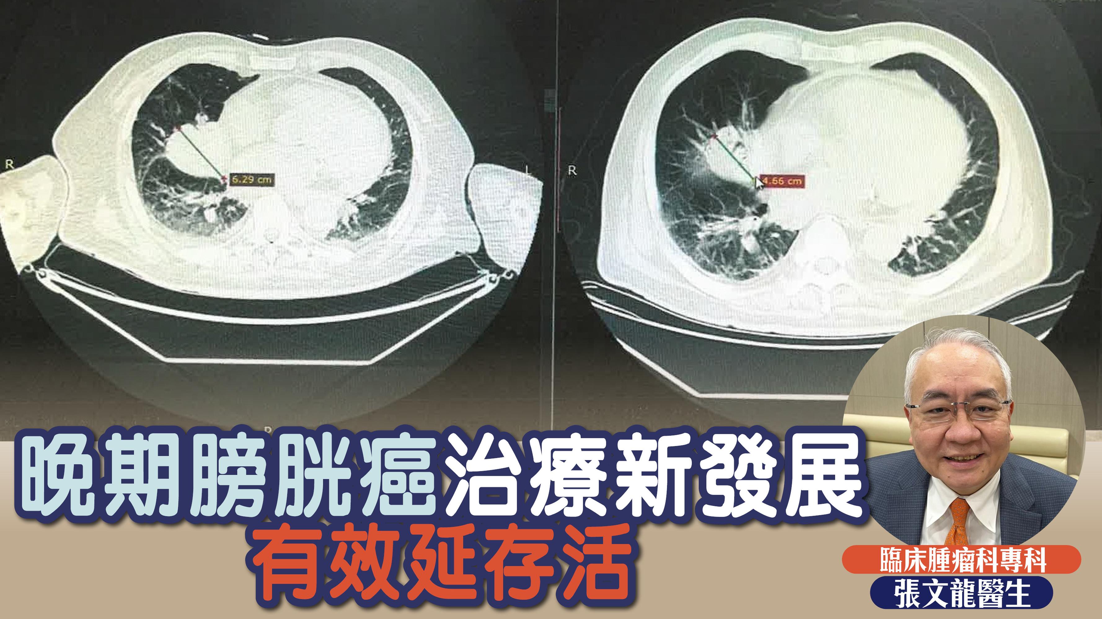 晚期膀胱癌治療新發展 有效延存活