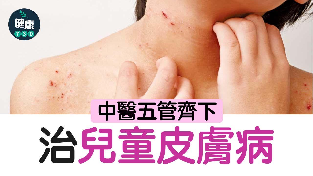 中醫五管齊下 治兒童皮膚病