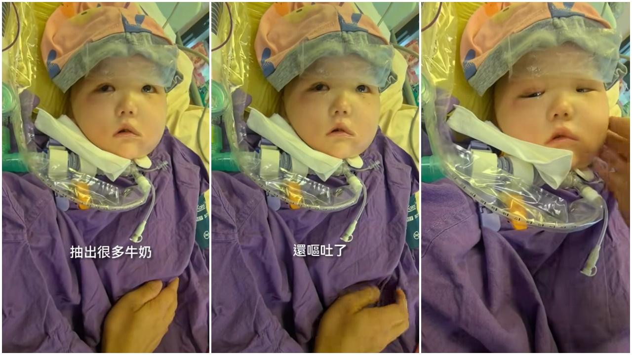 天瑜腸臟不蠕動暫禁進食