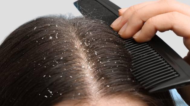 就咁洗頭未夠！治療病態性頭皮要針對原因對症下藥