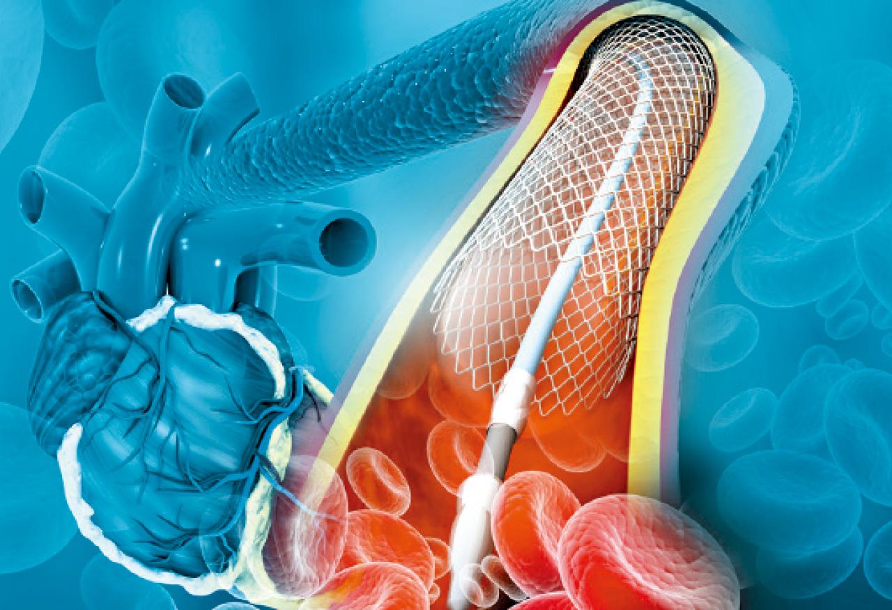 冠狀動脈鈣化血管處理的新技術