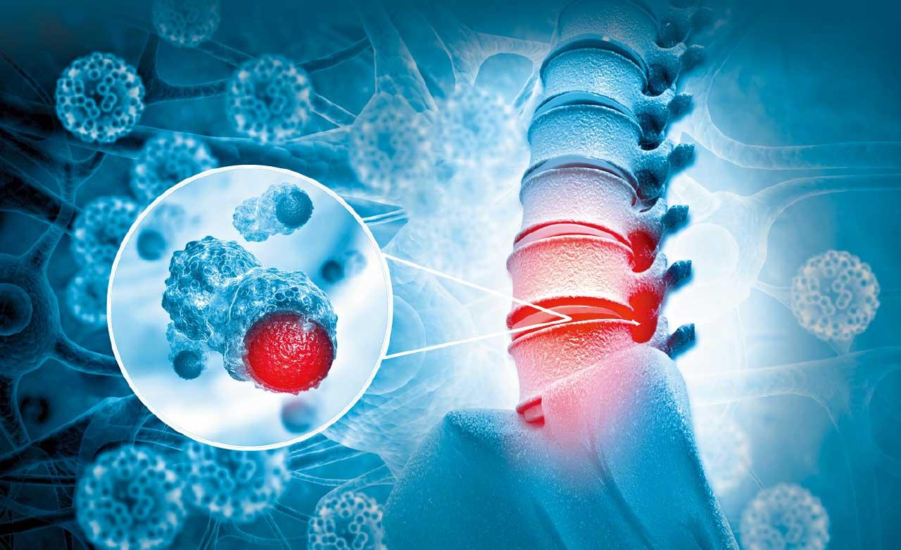 罕見惡性骨肉瘤 尤文氏肉瘤