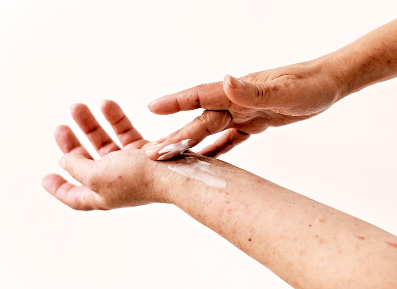 中醫治療濕疹的作用與效益