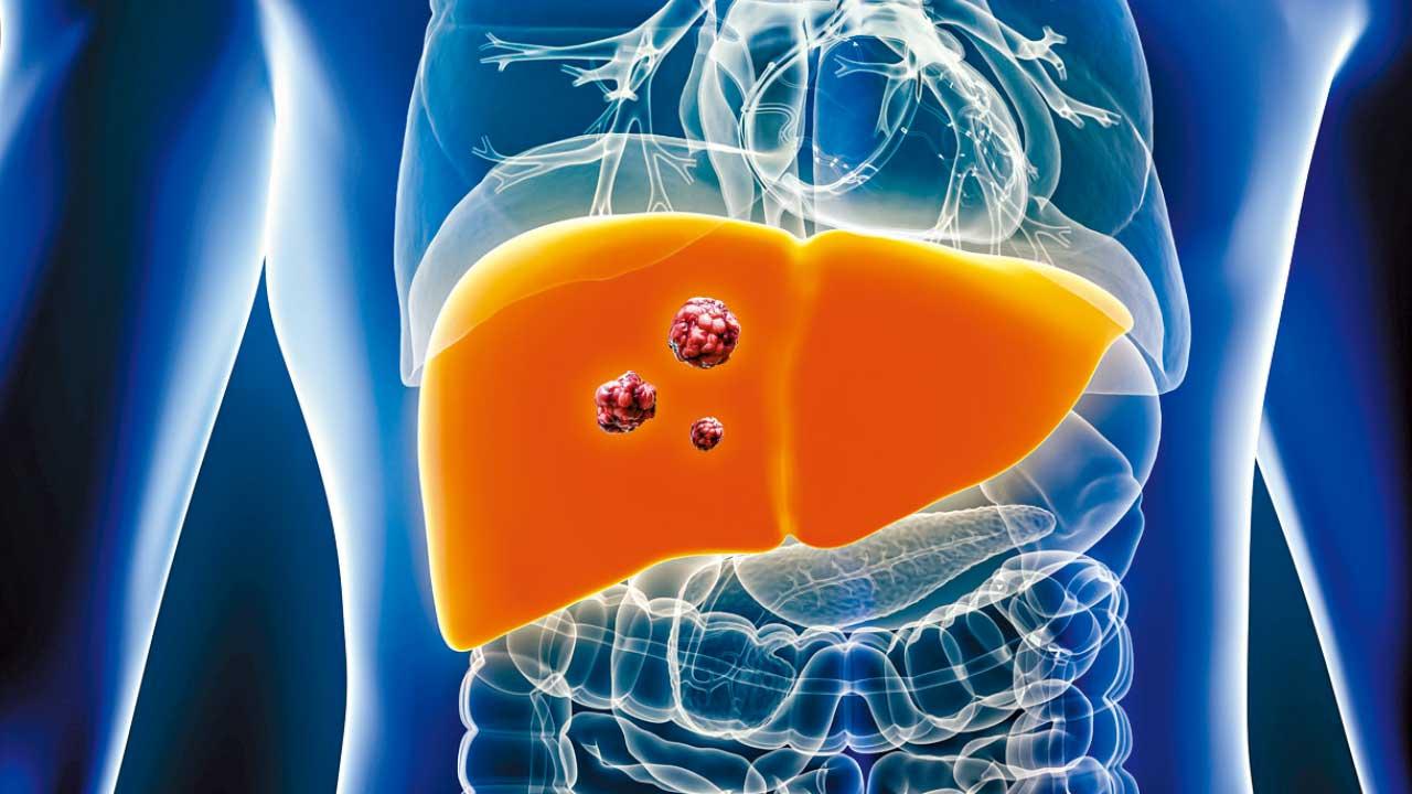 肝癌免疫治療易現抗藥性 中大研究望成治療指引