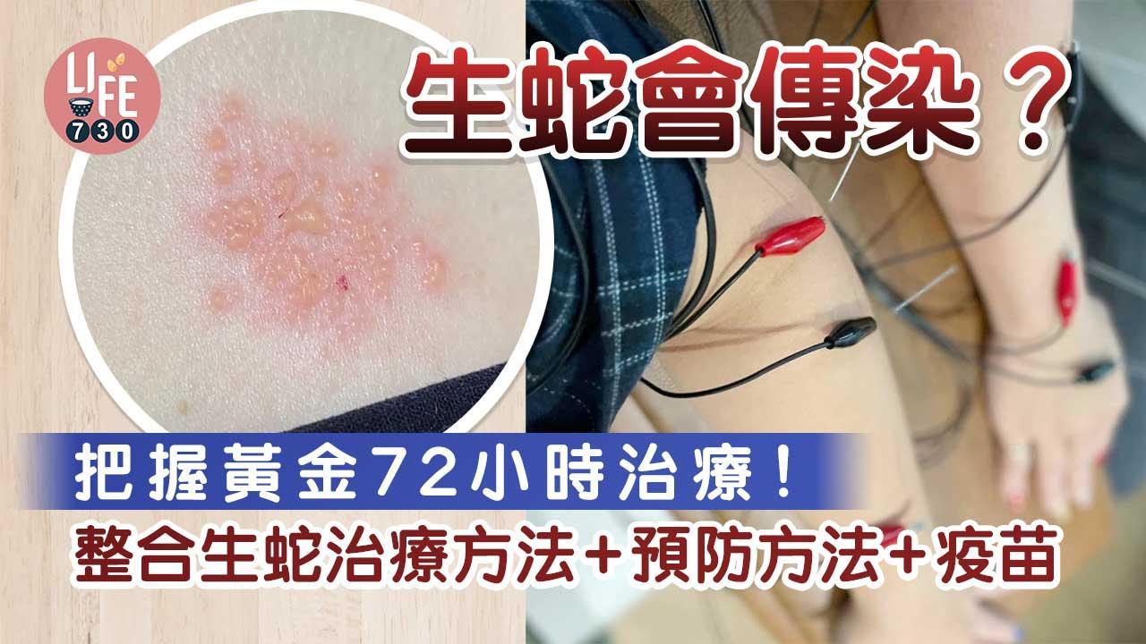 生蛇｜生蛇會傳染？把握黃金72小時治療！整合生蛇治療方法+預防方法+疫苗（am730製圖）